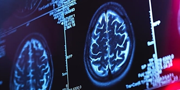 يمكن   لخوارزمية جديدة تحديد التغيرات الدماغية قبل الإصابة بمرض الزهايمر بدقة تزيد عن 99٪